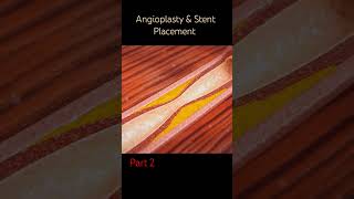 Coronary Artery Disease Angioplasty & Stent Placement