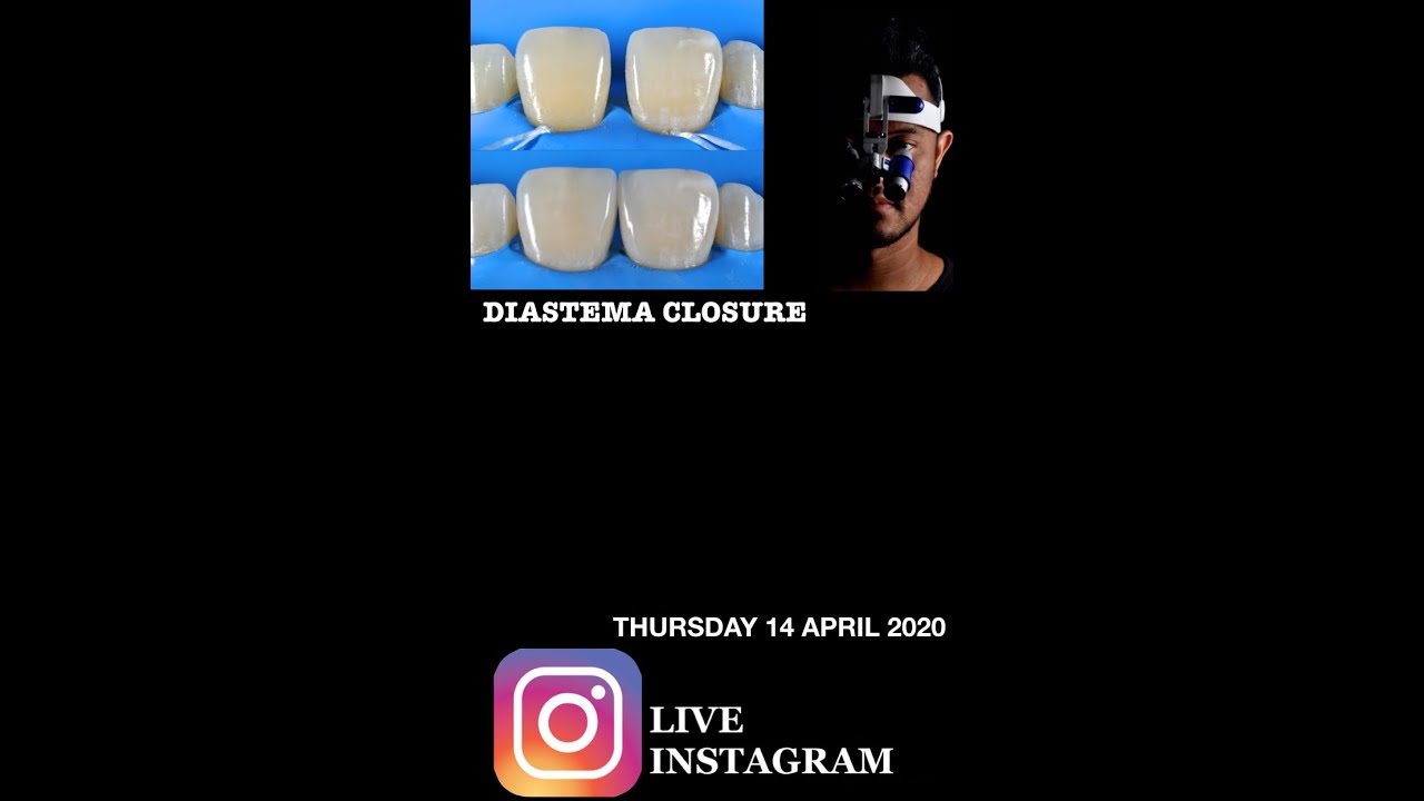 Diastema Closure Composite Instagram Live 14 April 2020 part 1