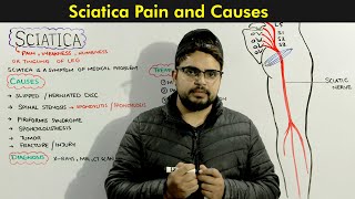 Sciatica: Symptoms, Causes and Treatments of Sciatic nerve