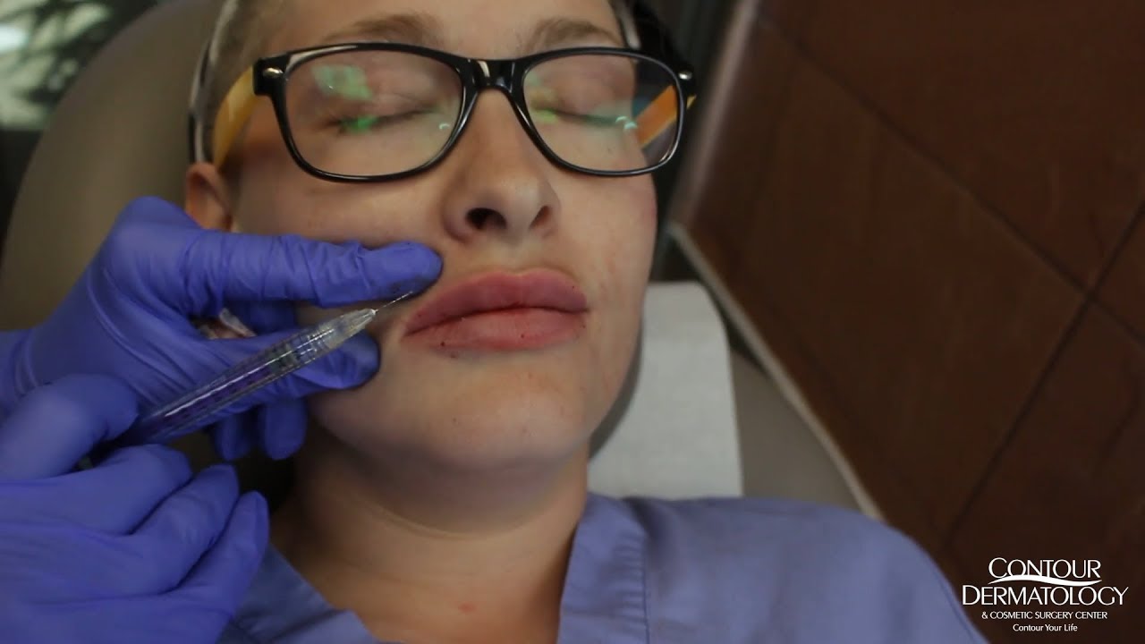 Female Lip Enhancement with Vollure Lip Fillers Before and After YouTube