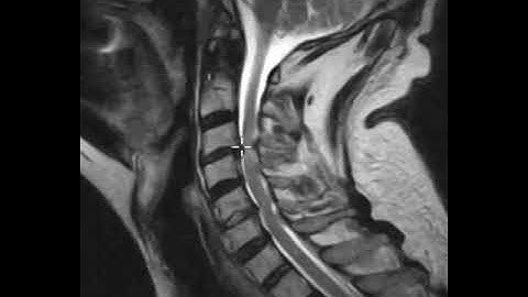 Cervical canal stenosis and spinal cord atrophy