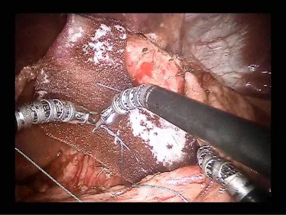 robotic lap paraesoph/nissen with mesh in under 30 minutes houston zoo