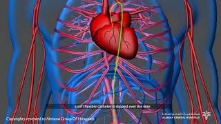 كيف تتم عملية قسطرة القلب؟