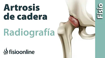 ¿Puede verse la artritis de cadera en una radiografía?