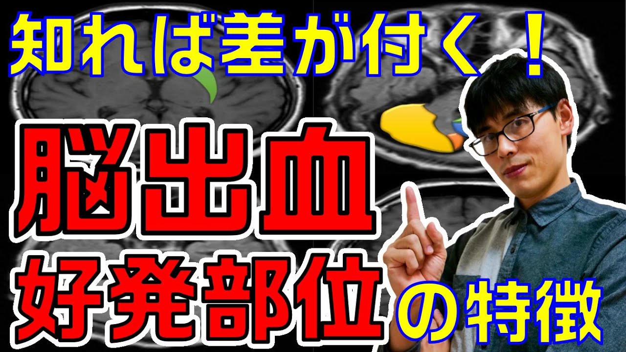 【脳卒中】皆意外と知らない！脳出血の好発部位と好発部位毎の特徴を解説します！