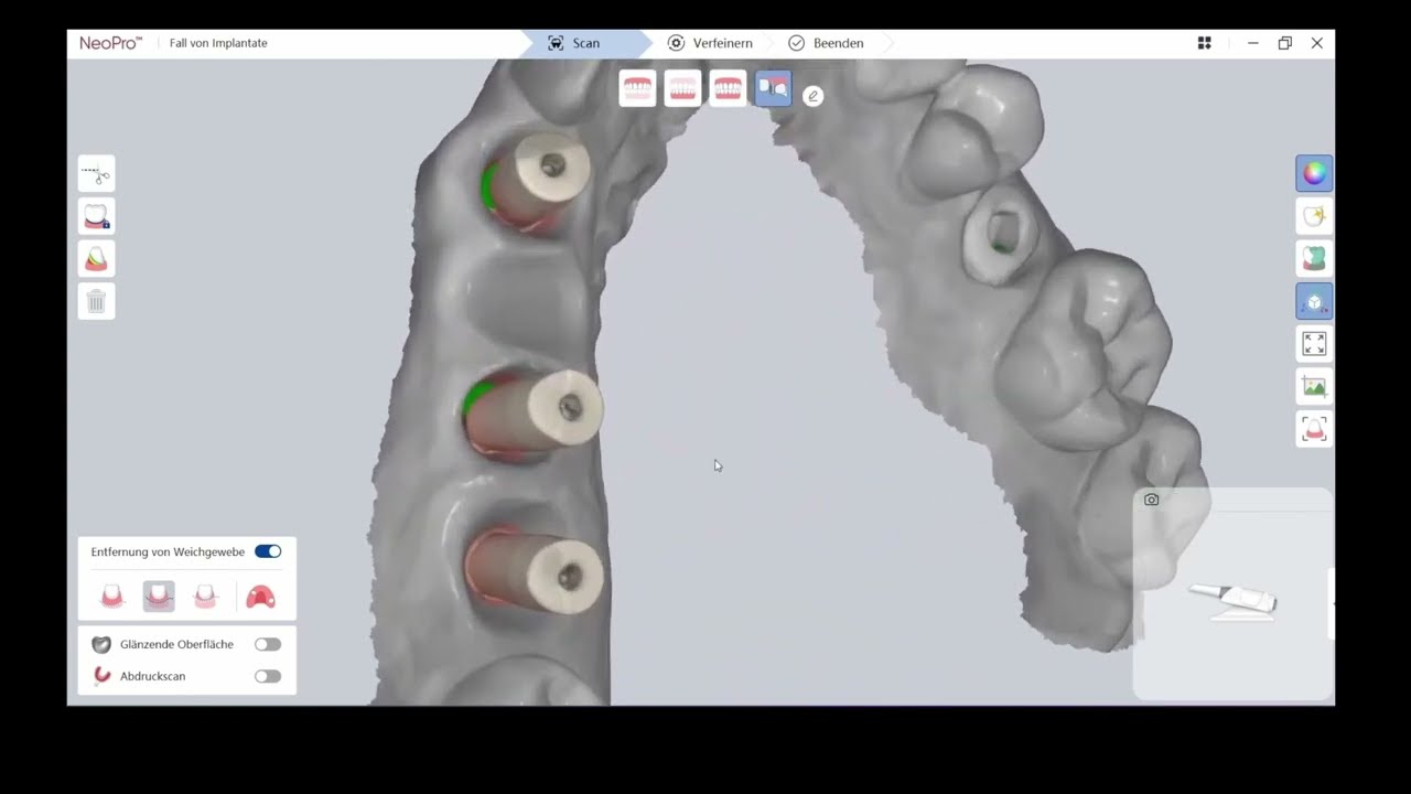NeoScan Tutorial: Implantat-Patienten scannen mit ScanBody