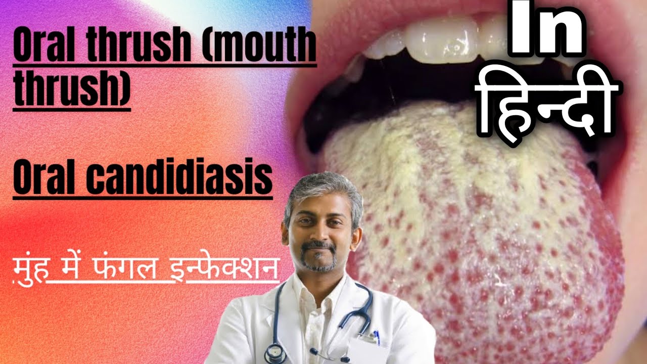 मुंह में फंगल इन्फेक्शन oral candidiasis in hindi YouTube