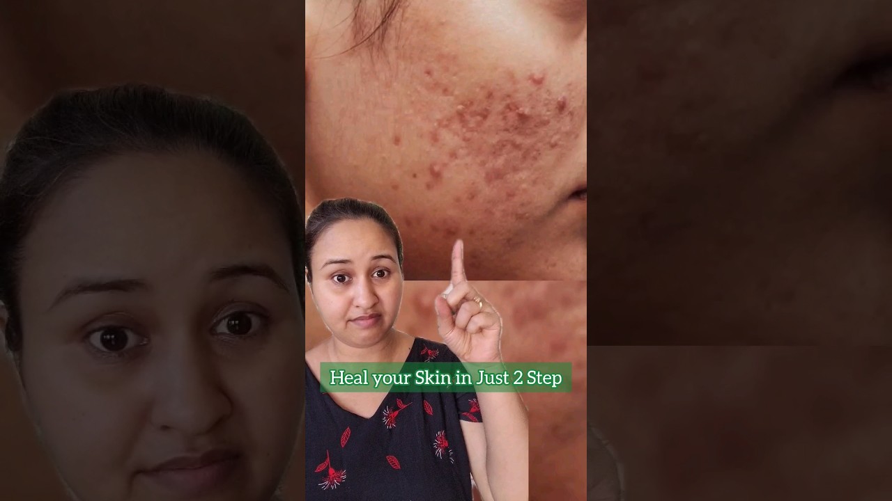 Dot & Key CICA DAY CREAM + Facewash for OILY, ACNE PRONE & SENSITIVE SKIN 