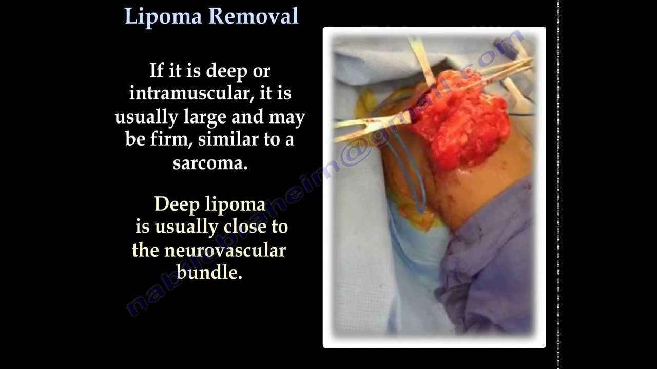 shoulder Lipoma, fatty tumor - Everything You Need To Know - Dr. Nabil