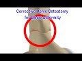 Corrective Dome Osteotomy for Cubitus Varus and Valgus Deformity