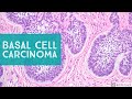 Basal Cell Carcinoma (BCC) 101 - Dermpath Basics Explained by a Dermatopathologist
