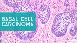 Basal Cell Carcinoma (BCC) 101 - Dermpath Basics Explained by a Dermatopathologist screenshot 4