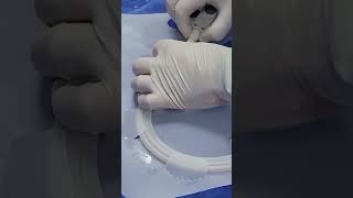 #SHORTS#CAROTID STENTING IN A NEAR OCCLUSION CASE#IR FACILITIES TREATMENT
