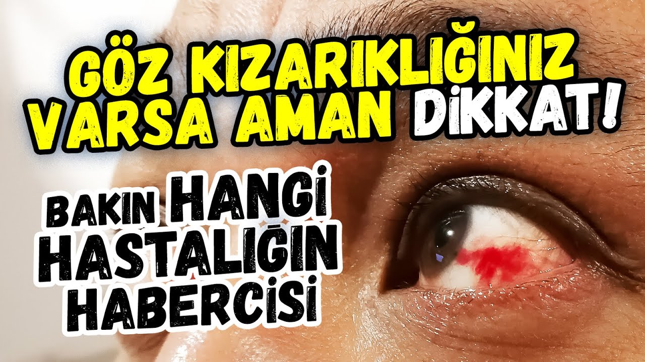 GÖZ KIZARIKLIĞI NEYİN HABERCİSİ? Göz eti, göz kanlanması neden olur