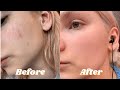 Acne Rosacea Skincare Routine | Isntree, Sand & Sky, The Ordinary, La Roche Posay & VT Cosmetics