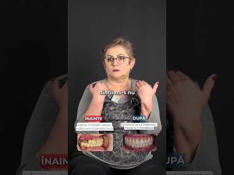 Pacientă DentalCare Sîrbu despre tratament: All-on-X, 5 implanturi sus și 4 jos