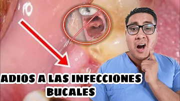 ¿Cómo previenen los dentistas la alveolitis seca?