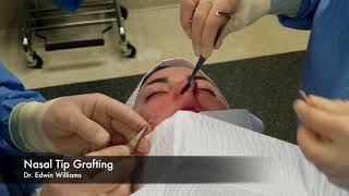 Tip Grafting in Rhinoplasty by Using the Endonasal or Closed Approach.