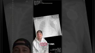 I Discuss My X-Ray With Lvad Inside My Heart