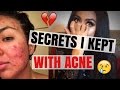 Dark Secrets Revealed: WHAT NO ONE SAYS ABOUT ACNE