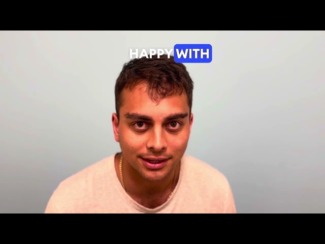 Traumatic Loss of Eyebrows, Eyebrow Scars, Eyebrow Hair Transplant Testimonial Dallas