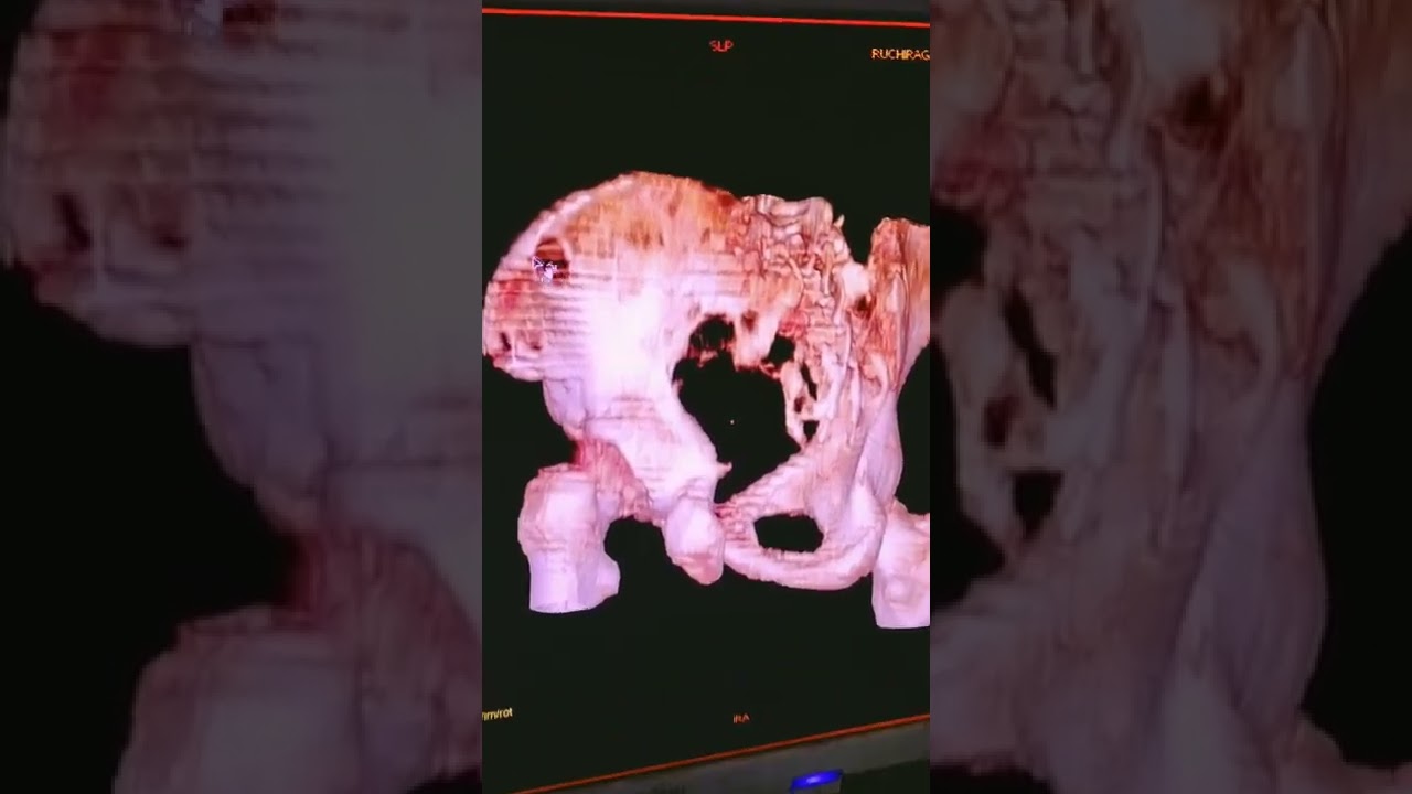 osteolytic metastatic deposits in pelvic bones