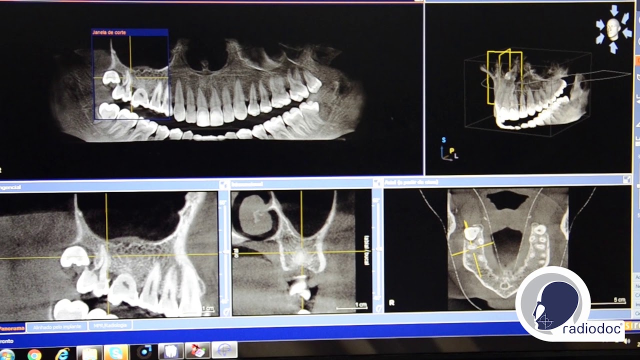 Tomografia na Odontologia