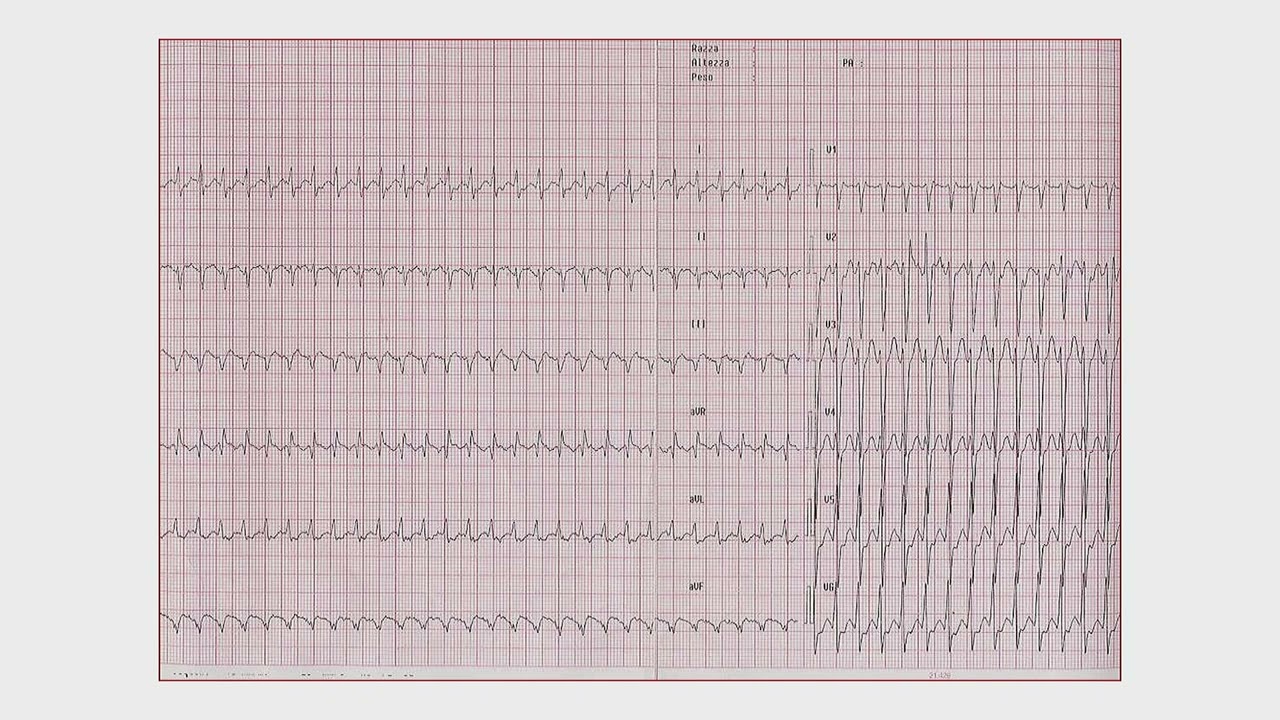 Corso MET ECG e Aritmie   Parte 1