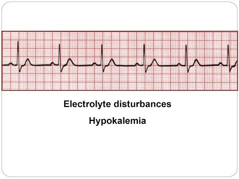 ecg-ion-abnormalities-hypokalemia-2018