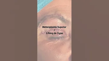 ¿La blefaroplastia levanta cejas?