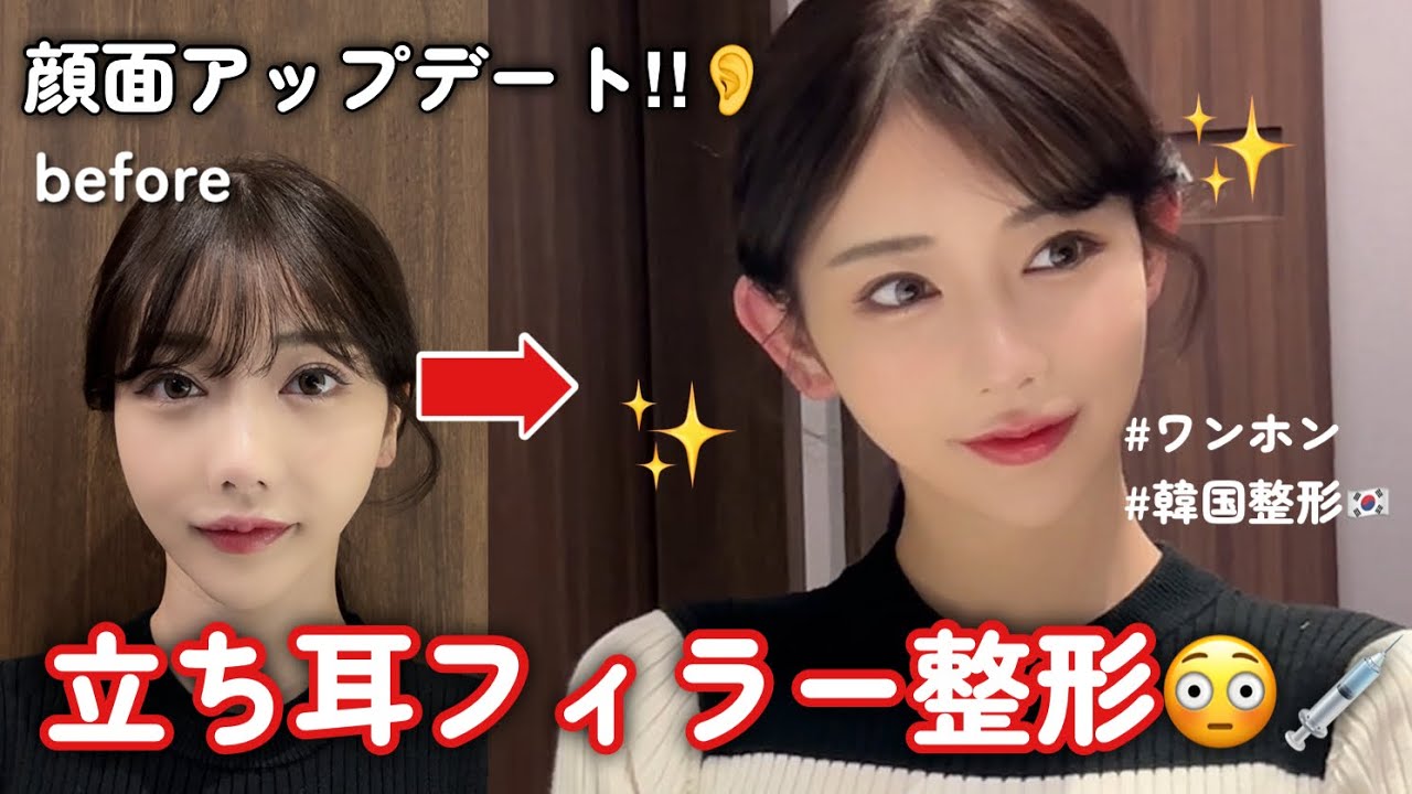 立ち耳フィラー整形👂💉で顔変わり過ぎた！！！【韓国整形】