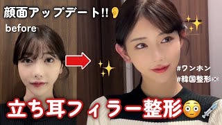 立ち耳フィラー整形