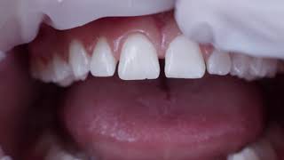 Clinical Case: Minimally-invasive diastema closure with Venus Pearl