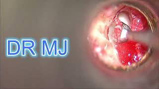 RIGHT LASER STAPEDOTOMY WITH TRUBLUE LASER, AND FAT SEALING OF OVAL WINDOW