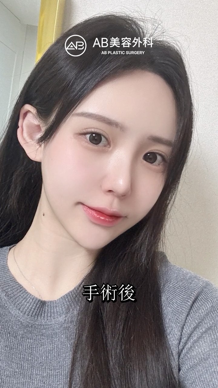 輪郭整形＋額縮小でここまで変わる？ #shorts