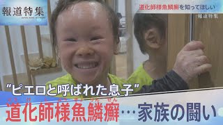 ピエロと呼ばれた息子”道化師様魚鱗癬【報道特集】 - YouTube 