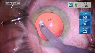 Managing Reverse Pupillary Block in a High Myope, Toric IOL
