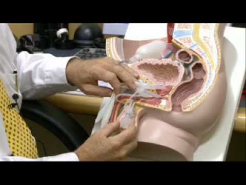 Penile Implants Treatment Dr Chris Love Australia