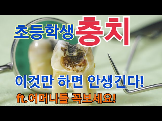이만 잘 닦으면 충치가 없을까? 아무도 모르는 초등학생 충치예방법!