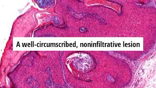 Pathology of Pilar Sheath Acanthoma by Dr Sampurna Roy MD screenshot 5