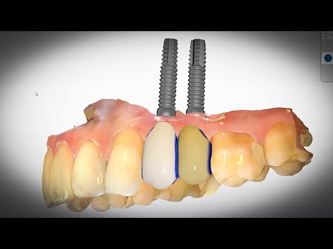 Video: Dental Prosthetics Or Implantation?