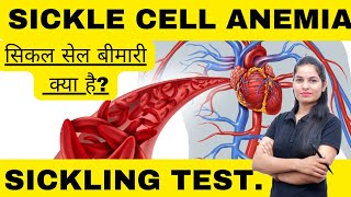 Sickle cell Anemia in hindi | Sickle cell test | Hematology Lecture | MLT Education Point