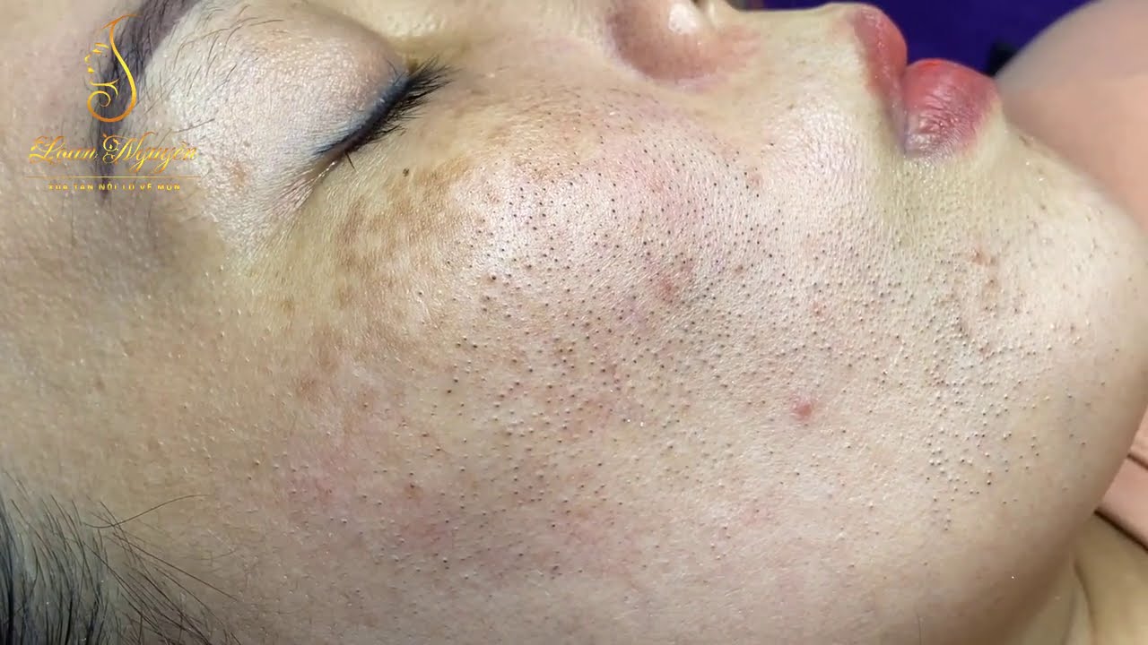 Eliminate a lot of blackheads for female clients (276_ep1)