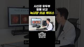 시신경 유두부 함몰 비교 녹내장 의심 케이스 l 좋은사람들성모안과 박성진 원장