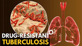 Tuberculosis, Causes, Signs and Symptoms, Diagnosis and Treatment.