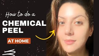 How to do Chemical Peel at Home, How to do Chemical Peel Treatment at Home Chemical peel kaise karen