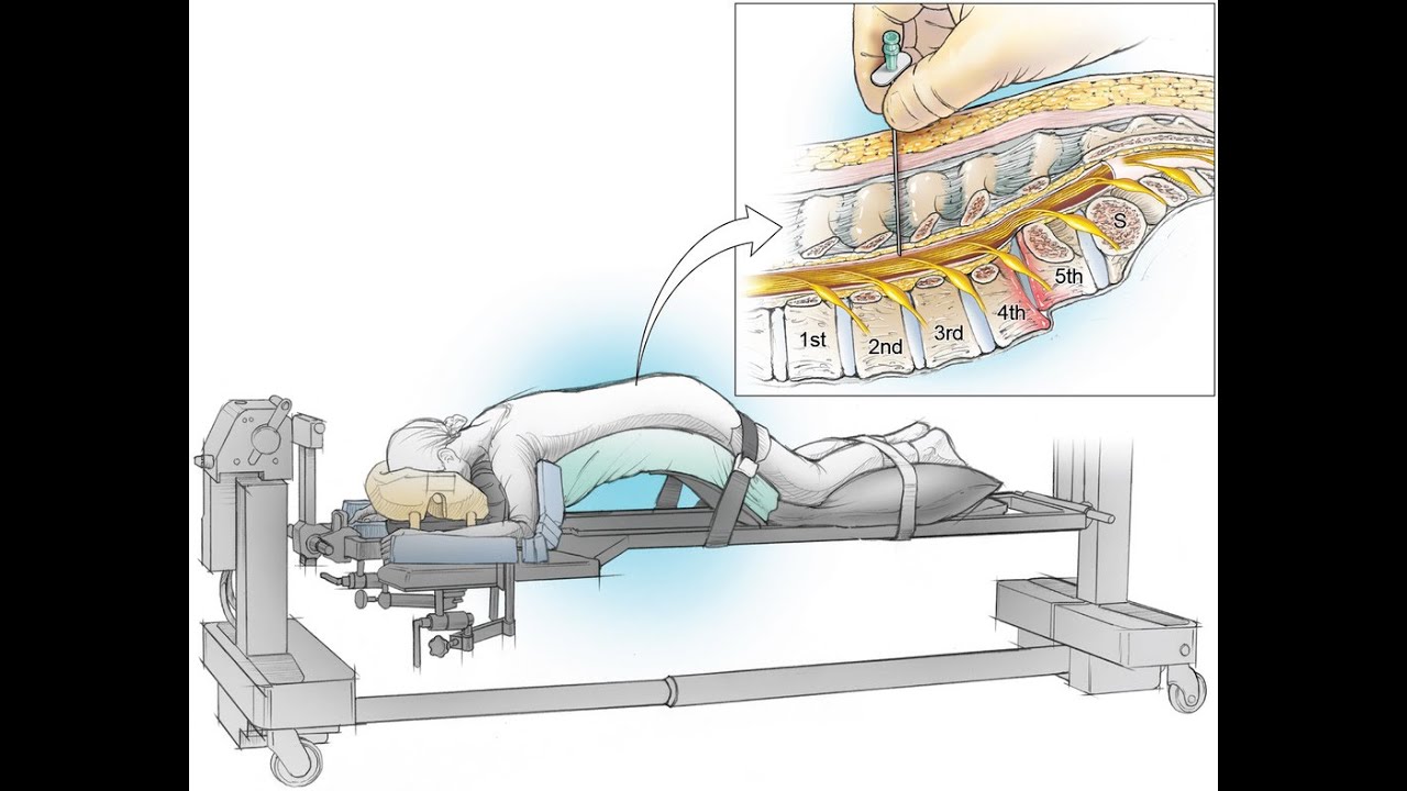 Χωρίς γενική αναισθησία, Ημερήσια ελάχιστα επεμβατική αποσυμπίεση, για την θεραπεία της ισχιαλγίας.
