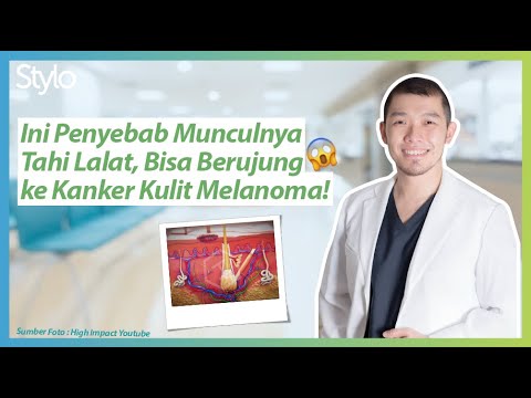 Begini Cara Tahi Lalat Terbentuk & Kanker Melanoma di Kulit (Penyebab, Ciri-ciri, Bahaya) | Stylo.ID