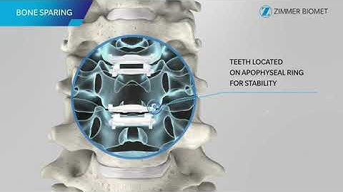 Zimmer Biomet: Mobi C Product Animation