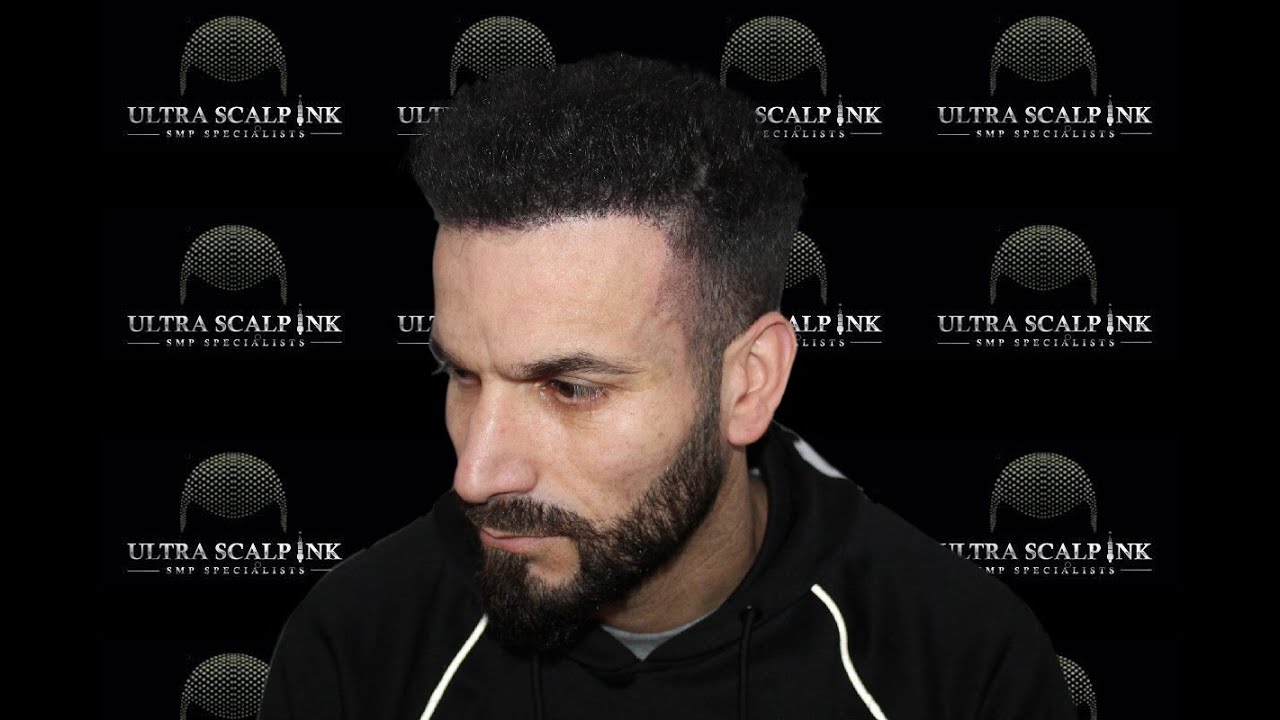 I Have A Busy Lifestyle  How Will My Scalp Micropigmentation Appointments Fit Into It?